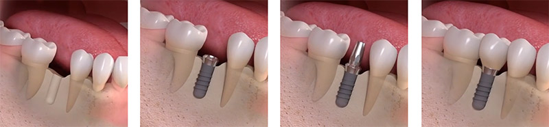 Replacing Single Tooth in Brooklyn NY